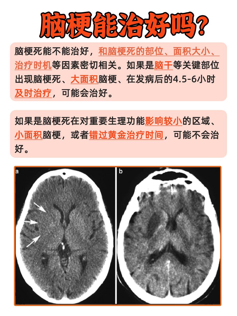 脑梗死能否被治好?看完心中有底