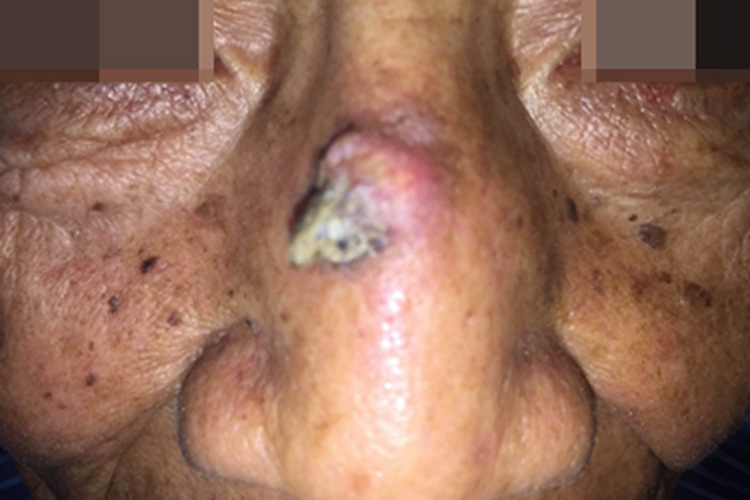 基底细胞瘤鼻部肿块图
