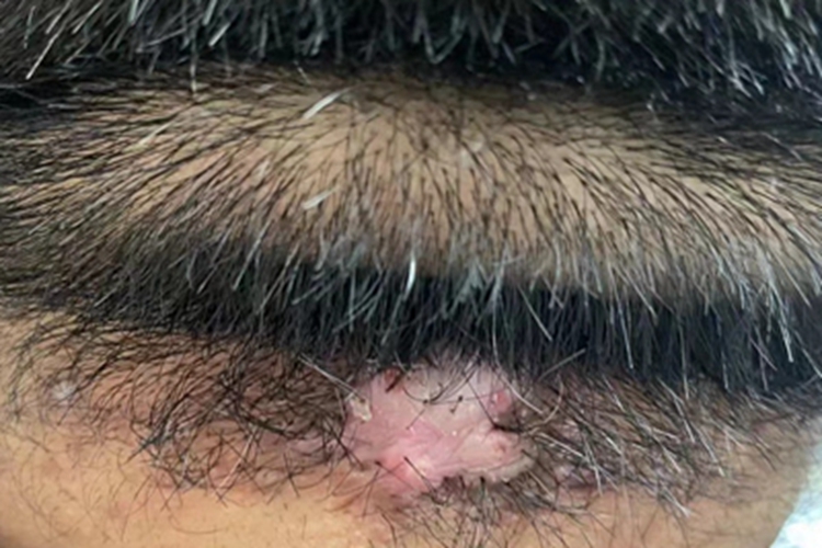 项部瘢痕疙瘩性毛囊炎头皮硬块图 项部瘢痕疙瘩性毛囊炎头皮硬块图