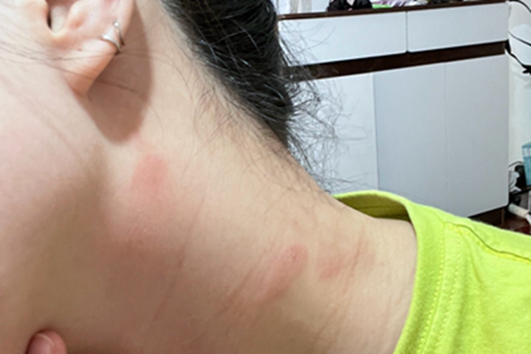 亚急性接触性皮炎侧颈红斑图