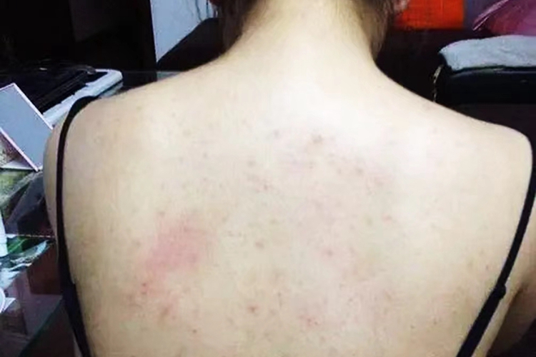 背部慢性过敏图
