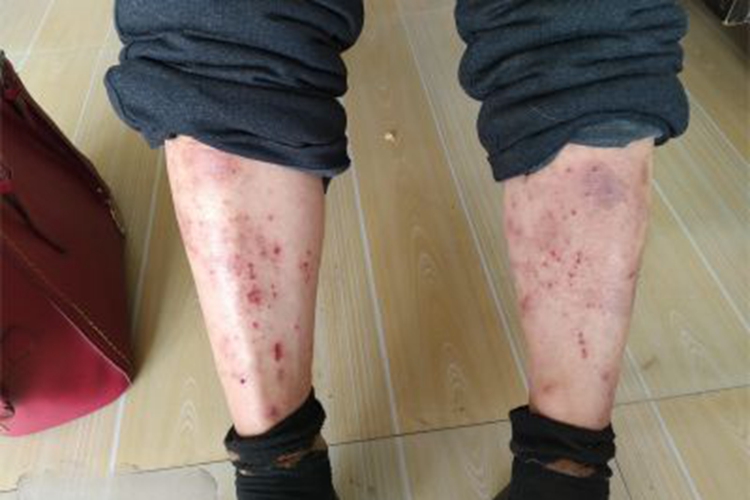 急性湿疹双侧小腿破损结痂图