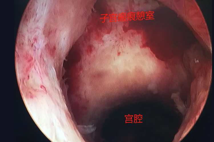 疤痕子宫图片大全图片