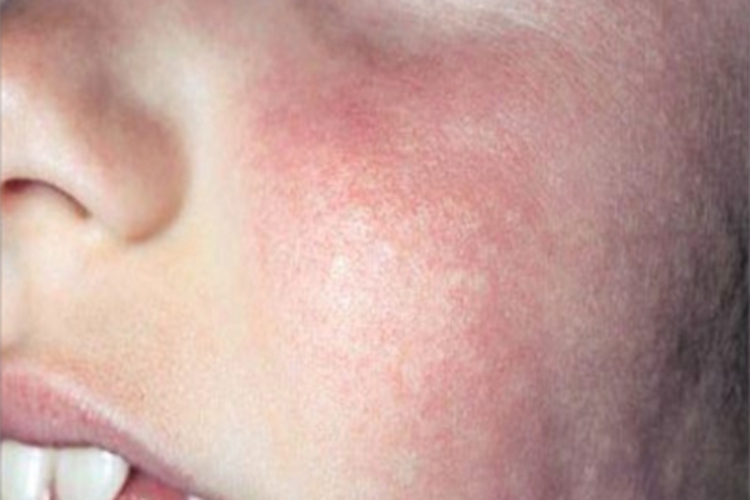 日光性荨麻疹丘疹图