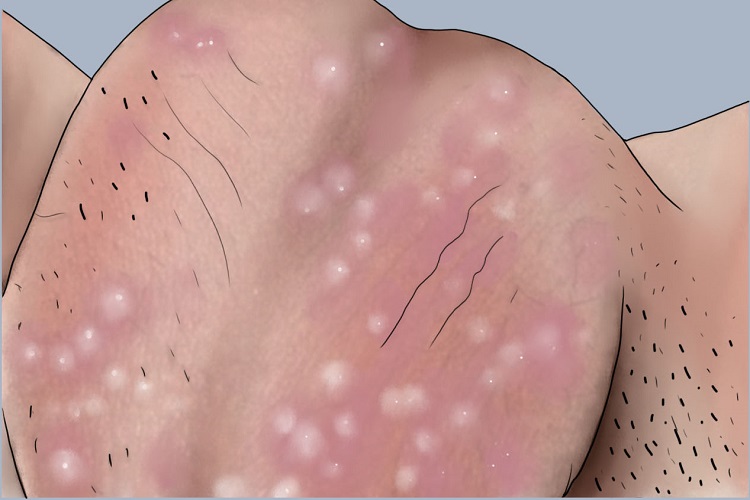 多发性皮脂腺囊肿阴囊手绘图