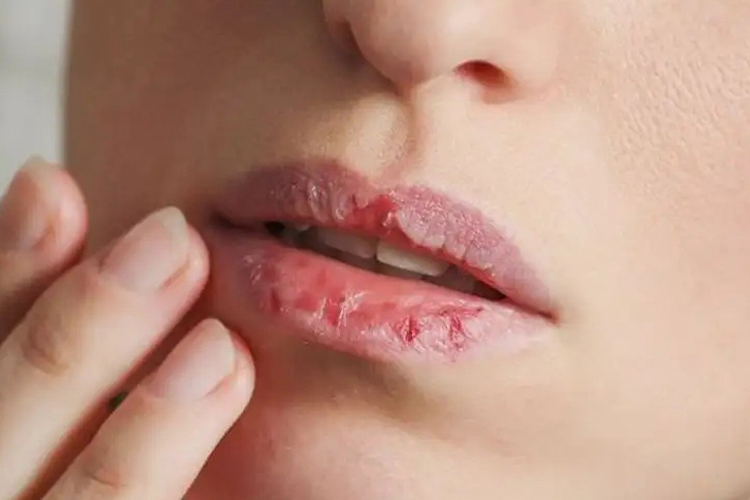剥脱性唇炎图