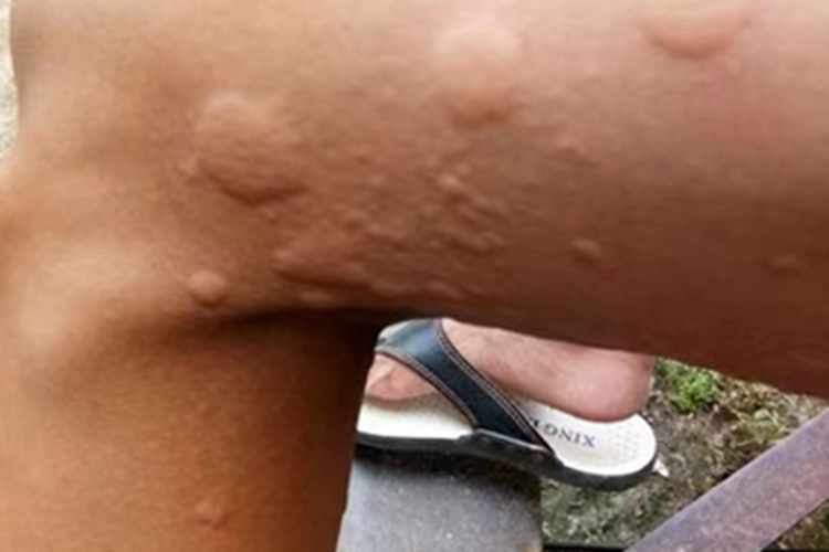 运动诱导性荨麻疹大腿症状图