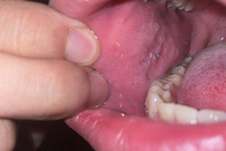 过敏性接触性口炎口腔症状图 过敏性接触性口炎口腔症状图