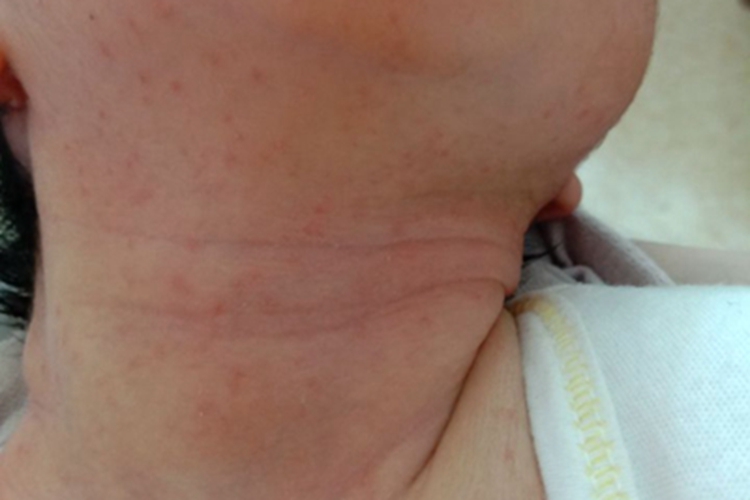 渗出型婴儿湿疹颈部症状图