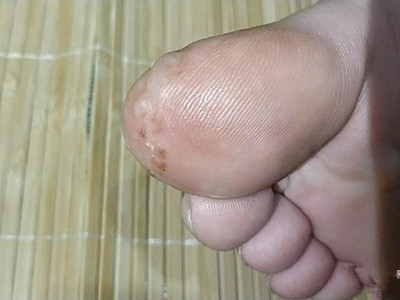 脚趾长水疱脚趾上有发白的水疱图.jpeg
