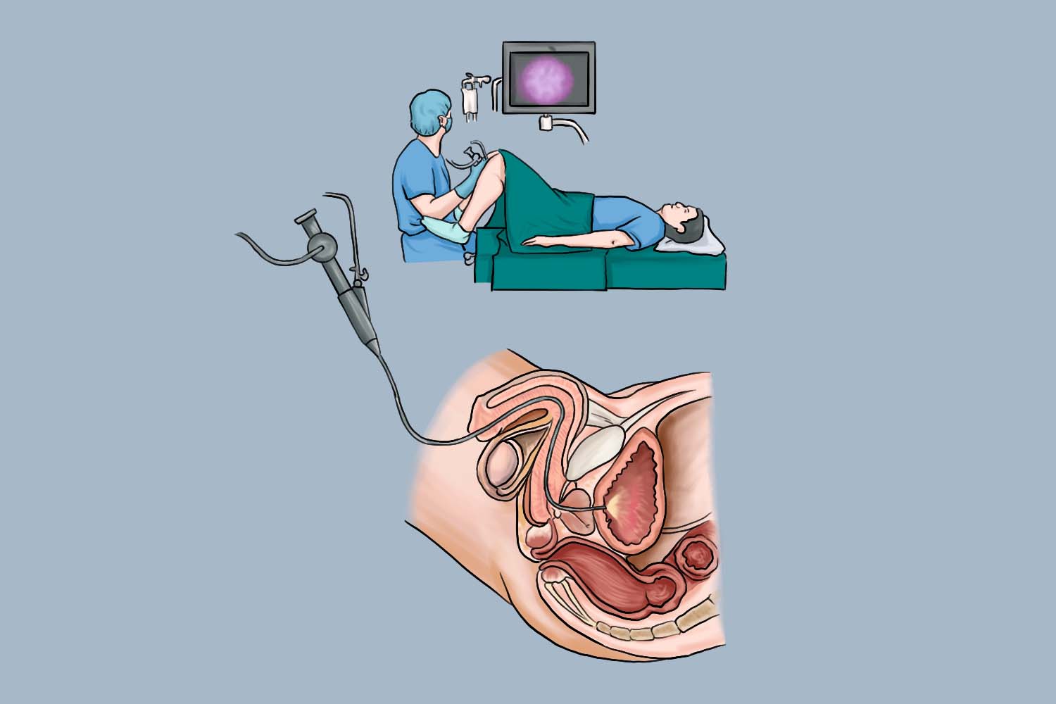 男性膀胱镜检查图