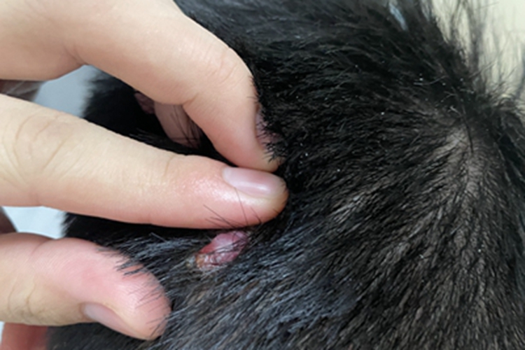 皮肤纤维瘤头皮软包图