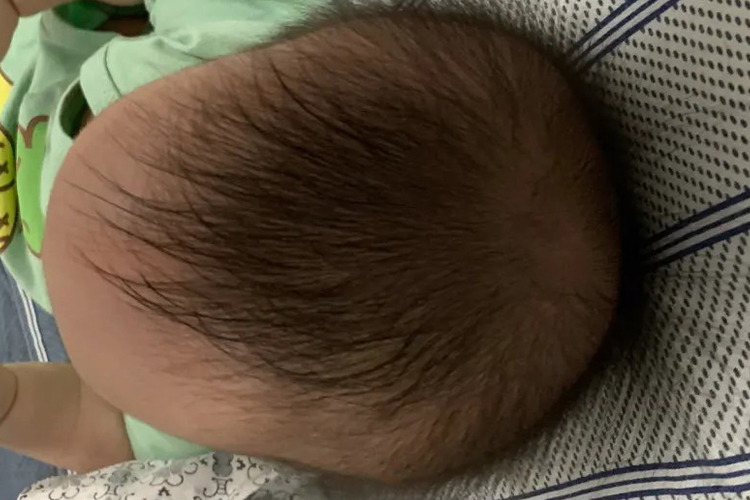 长头畸形图 长头畸形图