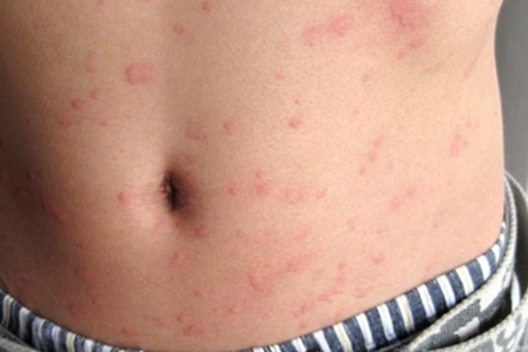 脓毒败血症疹丘疹图