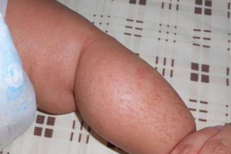 宝宝干性湿疹皮肤有淡红色裂纹图