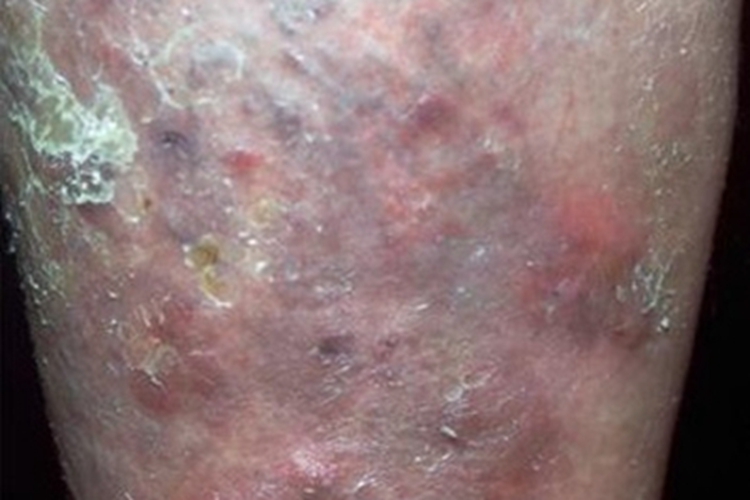 硬结性红斑小腿症状图