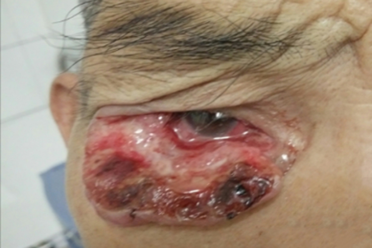 睑板腺癌眼睑肿块图