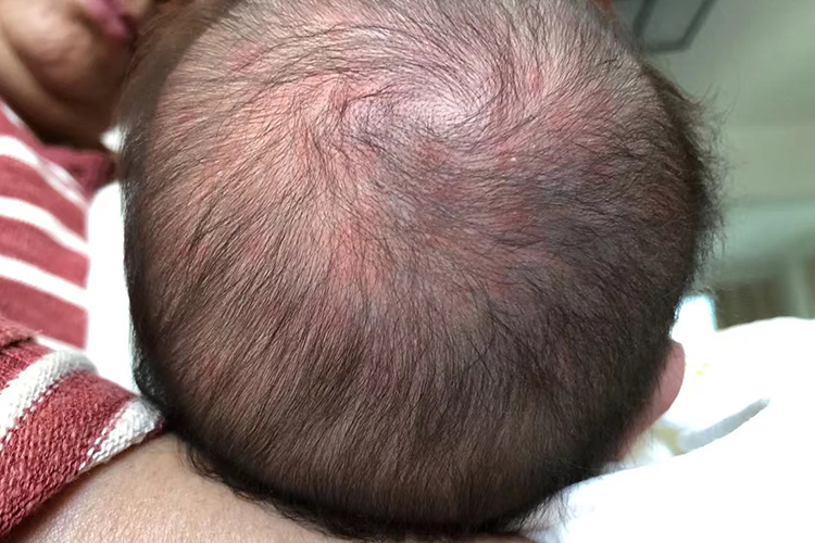 头皮红痱图 头皮红痱图