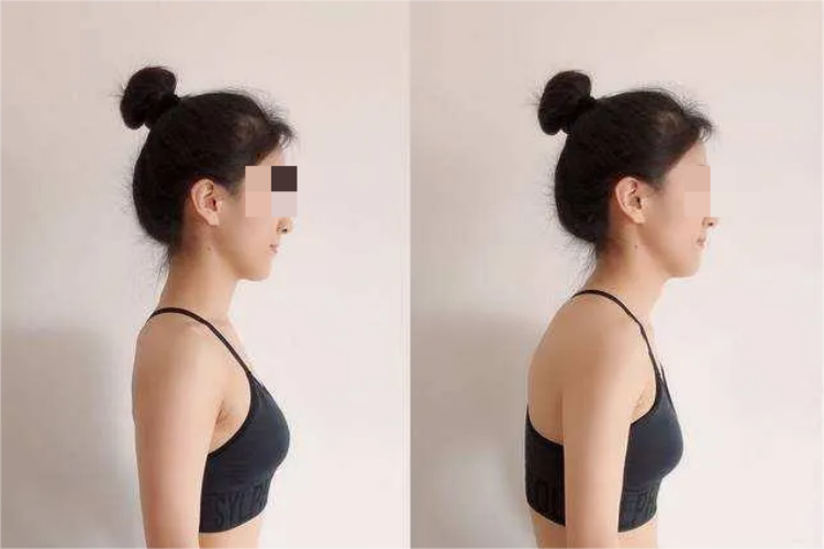 正常与肩膀内扣对比图