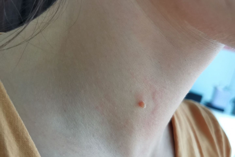 孩子脖子上长寻常疣图