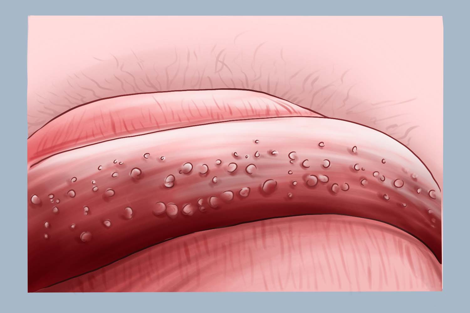 珍珠状阴茎丘疹图 珍珠状阴茎丘疹图