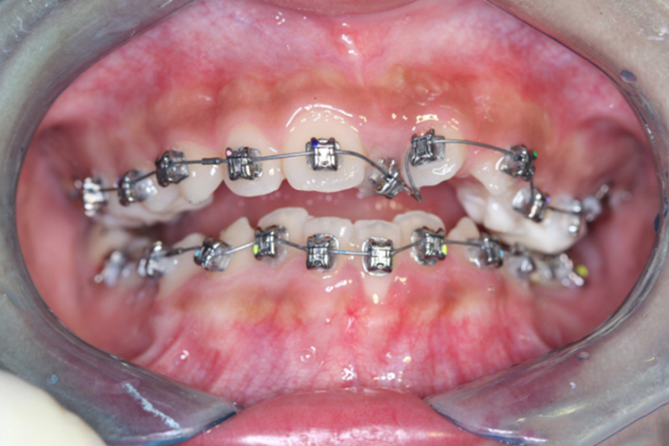 扭转牙正畸过程图