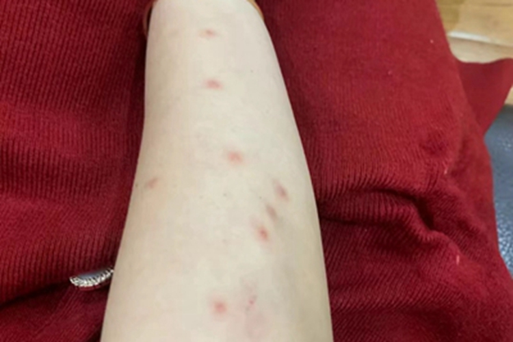 跳蚤叮咬胳膊小红疙瘩图
