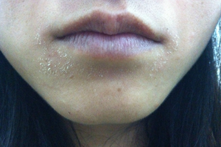 缺铁性贫血口周脱屑图