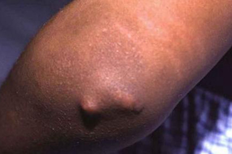 风湿热的皮肤表现症状图风湿热的皮肤表现包括环形红斑和皮下结节