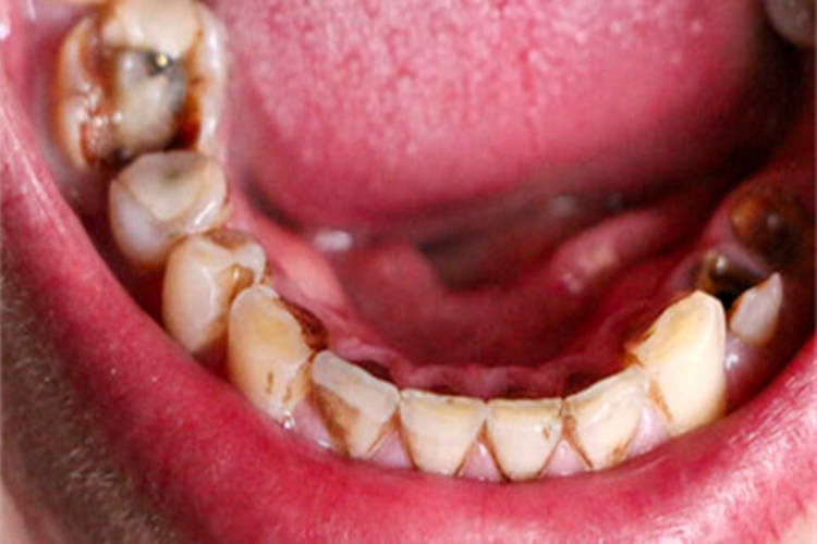 老年龋病深龋牙齿缺损图