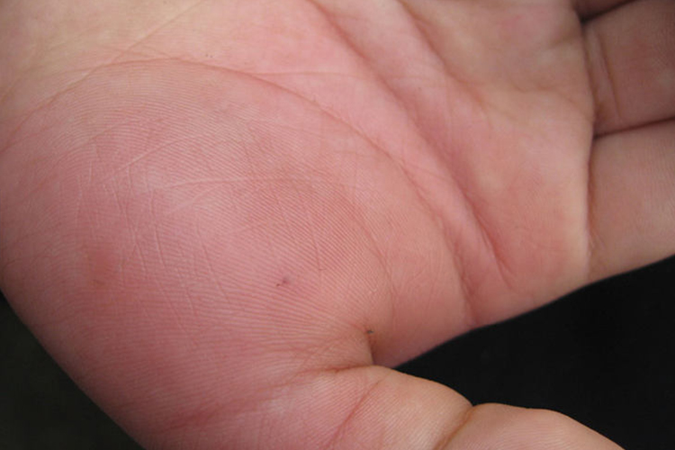 大面积肿胀性红斑图