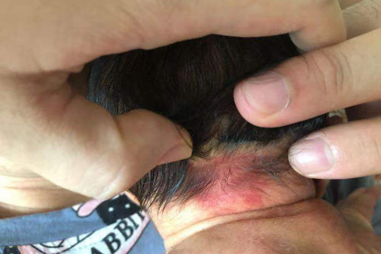 新生儿脖子后面鲜红斑痣图 新生儿脖子后面鲜红斑痣图