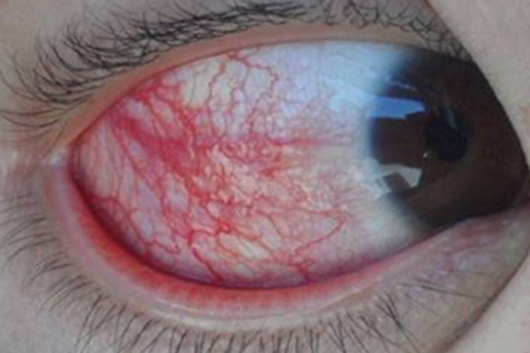腺病毒性角结膜炎眼球水肿图