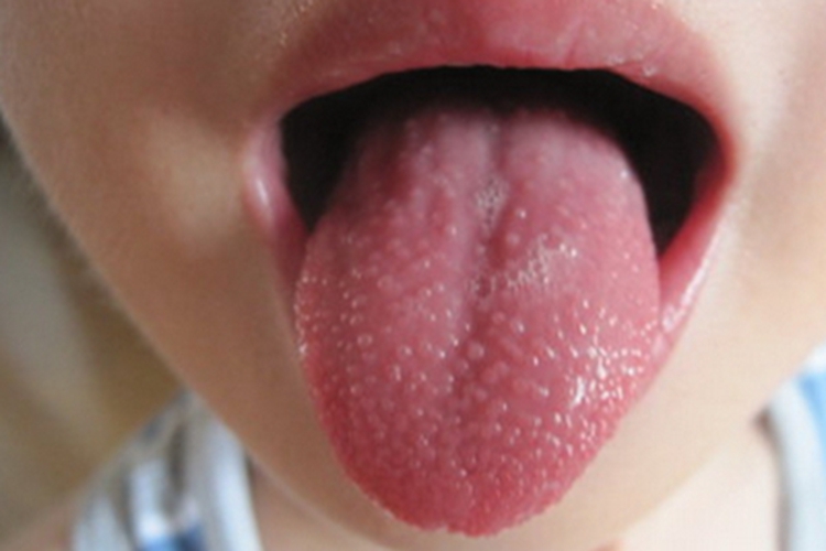 猩红热舌头症状图
