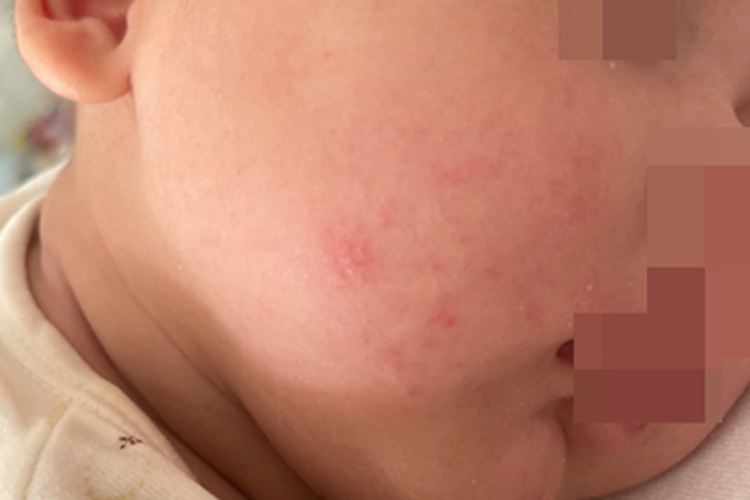 急性湿疹面部红点图