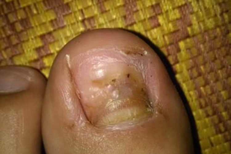 甲床炎脚趾甲症状图 甲床炎脚趾甲症状图