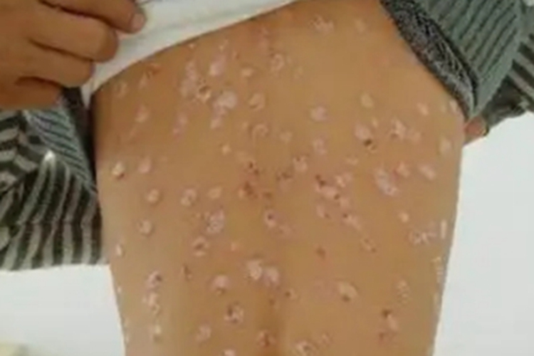 梅毒性白斑症状图