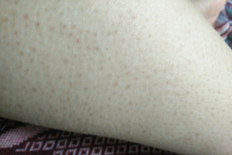 毛囊角化病小腿脱屑图