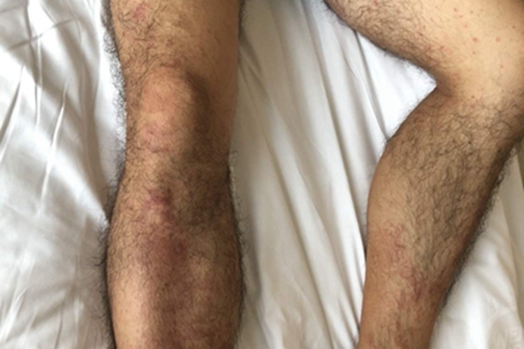 瘙痒症小腿小红疙瘩图 瘙痒症小腿小红疙瘩图