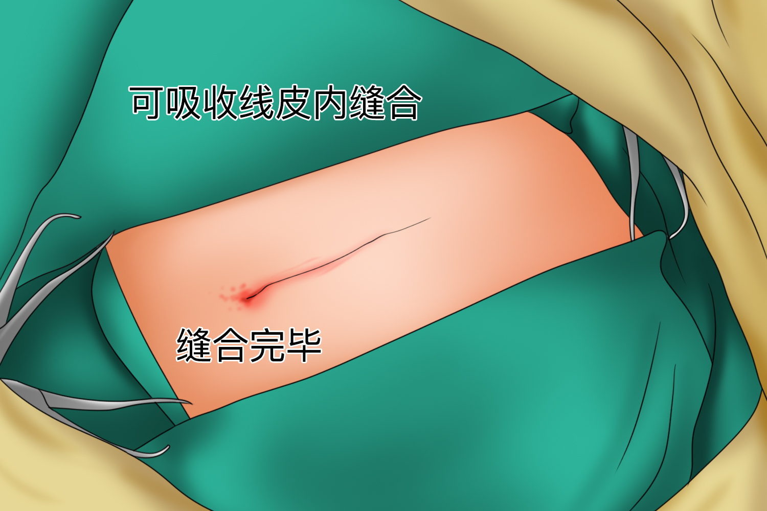 皮内缝合图