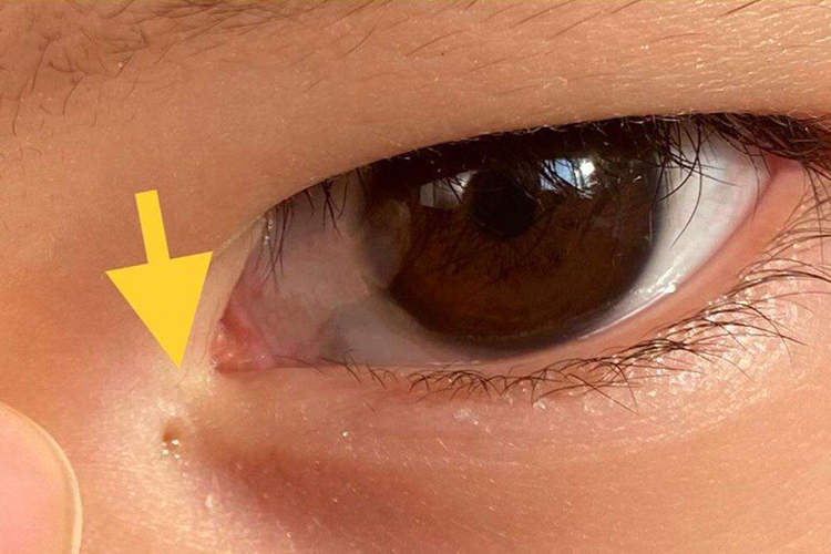 先天性泪囊瘘图