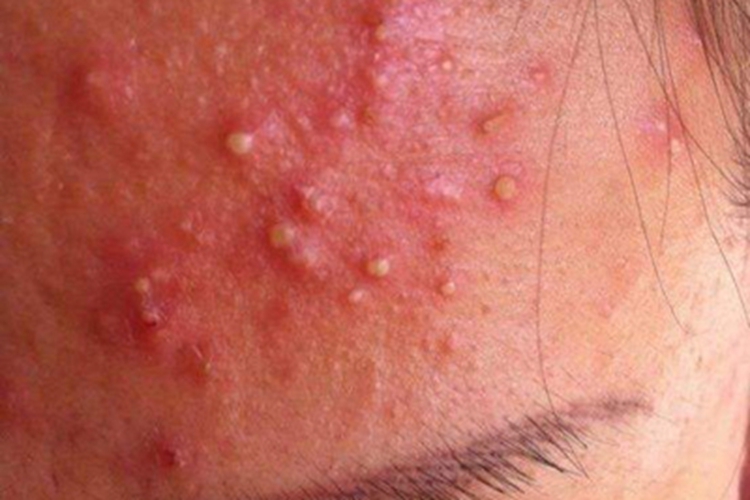 暴发性痤疮前额症状图 暴发性痤疮前额症状图