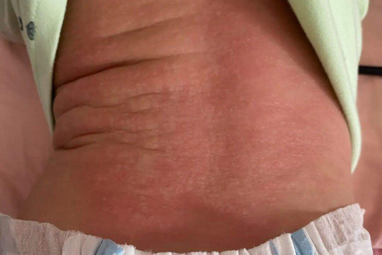 儿童背部痱子图