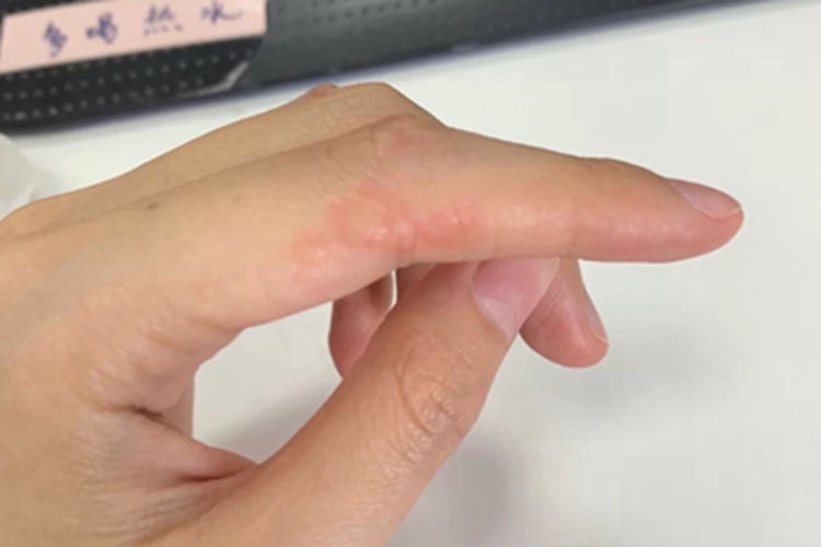 皮肤过敏红肿食指外侧有水疱图 皮肤过敏红肿食指外侧有水疱图