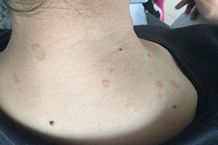 花斑糠疹颈部褐色斑图 花斑糠疹颈部褐色斑图