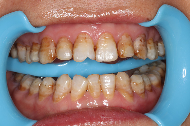 氟斑牙图 氟斑牙图