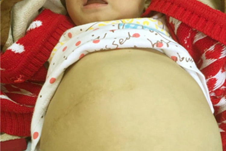 棘球蚴病肚子鼓胀图 棘球蚴病肚子鼓胀图