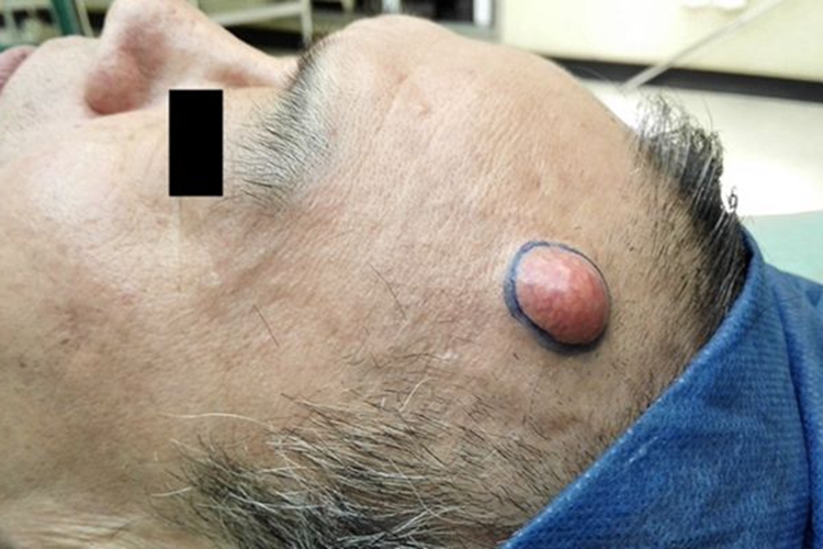 皮脂腺囊肿前额肿块图 皮脂腺囊肿前额肿块图