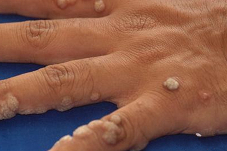 职业性疣赘手部症状图 职业性疣赘手部症状图