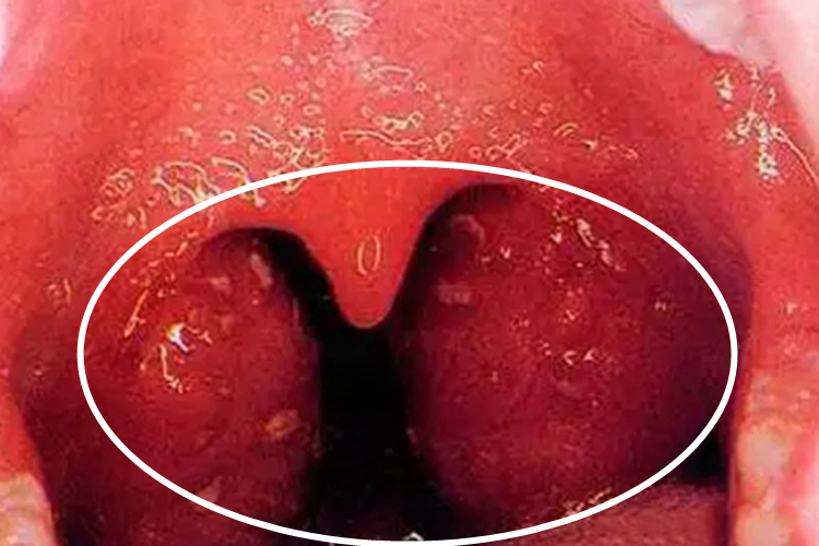 普通型猩红热扁桃体肿图